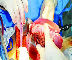   مصر اليوم - طرح علاج جديد الي الفشل الكلوى مع استخدام تقنية النانو