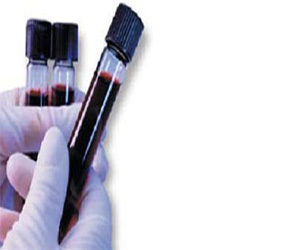   مصر اليوم - تحليل دم بسيط يمكنه التنبؤ بفرص خرف الشيخوخة