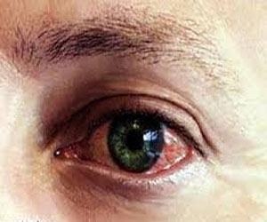   مصر اليوم - اختتام المخيم الطبي المجاني الأول لأمراض العيون في تعز