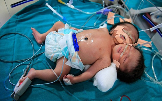   مصر اليوم - هنديّة تلد توأمًا بجسد واحد ورأسين يتقاسمان معظم أعضائهما الحيويّة