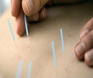   مصر اليوم - الوخز بالإبر أحدث العلاجات للقضاء علي حساسية الربيع