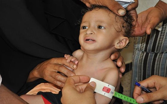   مصر اليوم - الـيونيسف تؤكّد أنّ أكثر من ربع مليون طفل يمني يُعانون سوء التغذيّة الحاد