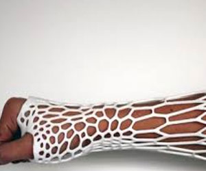   مصر اليوم - جبيرة طبعت بالطابعة ثلاثية الأبعاد تنقذ حياة طفل