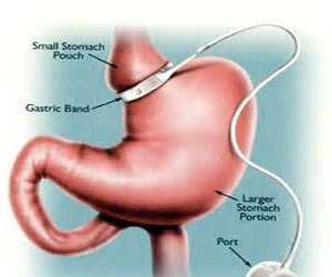   مصر اليوم - أطباء في المانيا يؤكدون أن عمليات تضييق المعدة لتخفيض أوزانهم تفيد أيضا لعلاج مرضى السكري