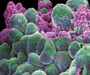   مصر اليوم - باحثون إيرانيون يتوصلون إلي طريقة لعلاج سرطان الرحم