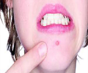   مصر اليوم - نصائح طبيعية للتخلص من البثور حول الفم