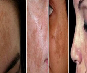   مصر اليوم - ثلث النساء البالغات 40 سنة يعانين من ظهور بقع بنية على الوجه واليدين