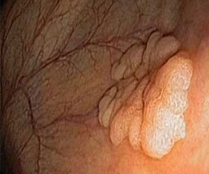   مصر اليوم - دواء كوبي لمعالجة سرطان الدماغ والقولون والرئة يسجل في 28 دولة أجنبية