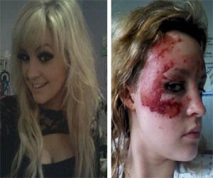   مصر اليوم - فتاة بريطانية تخوض مسابقة لملكات الجمال رغم اصابتها بحروق بالغة