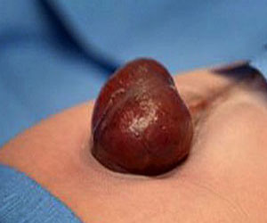   مصر اليوم - الاكتئاب يرفع نسبة الإصابة بقصور القلب