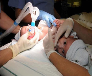   مصر اليوم - عملية فصل التوأم السيامي العراقي تمَّت بنجاح في الرياض