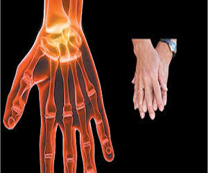   مصر اليوم - دراسة تُؤكّد أن التهاب المفاصل الروماتويدي يضرّ الكلى