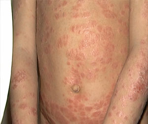   مصر اليوم - ستالرجين الفرنسي يحصل على الضوء الأخضر لتسويق عقار الحساسية الجديد