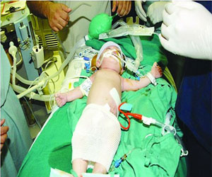   مصر اليوم - الفحوصات جارية لإنجاح فصل توأم سوري في الرياض