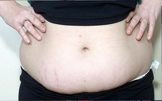   مصر اليوم - الآيقونة يخفي علامات تمدّد البطن والحروق