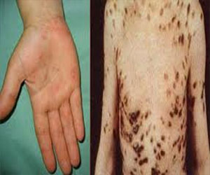   مصر اليوم - موريتانيا تنظم حملة وطنية ضد التهاب السحايا أكتوبر القادم