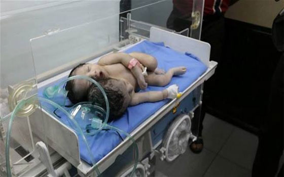   مصر اليوم - العراق يشهد الولادة الأولى لطفل برأسين في الناصريّة