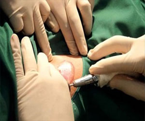   مصر اليوم - نجح فريق من العلماء البريطانيين في استزراع خلايا جلدية معمليًا