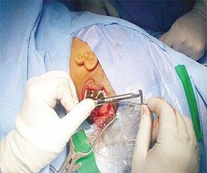   مصر اليوم - زراعة أول سماعة عظمية لامرأة تعاني ضعف السمع في السعودية