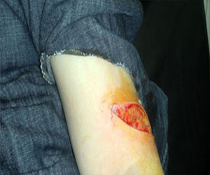   مصر اليوم - دراسة: بكتريا الجلد تؤثر في سرعة التئام الجروح