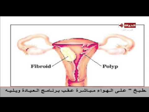 مراحل النزيف المهبلي حتى الأورام السرطانية