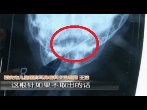 إزالة إبرة خياطة طولها 4 سم من حلق طفلة صغيرة