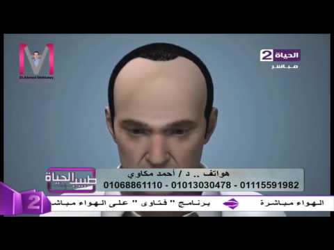 تعرف على تفاصيل عملية زراعة الشعر