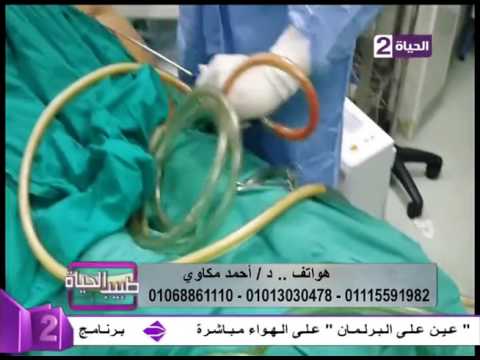 كيف تتم عملية شفط الدهون