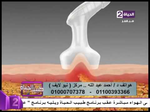 نتائج مبهرة فى شد ترهلات البطن