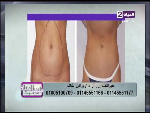 استشاري تجميل يُظهرنتائجًا مبهرة بعد شفط الدهون بالفيزر