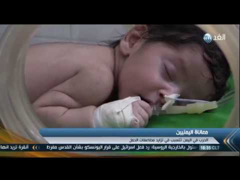تزايد حالات الوفاة لدى الأطفال حديثي الولادة في اليمن