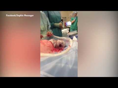 بالفيديو  طفل يزحف ويخرج بنفسه من بطن أمه أثناء ولادة قيصرية