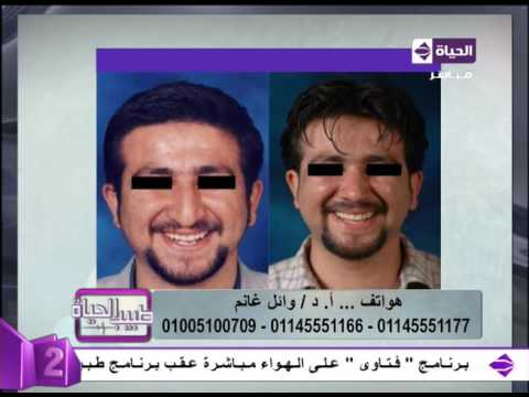 نتائج مبهرة بعد عملية تجميل الأنف