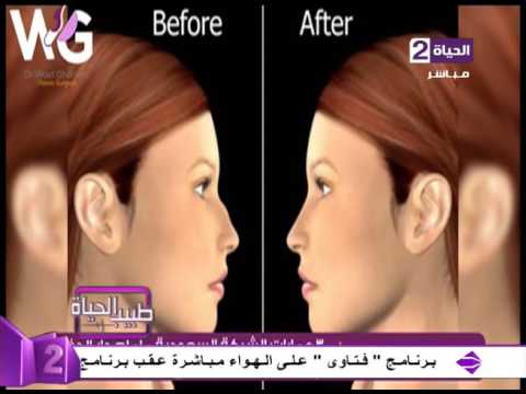 شرح مفصّل للعملية الجراحيّة التجميليّة للأنف
