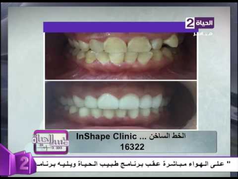 بالفيديو  نتائج مبهرة بعد عملية تجميل الأسنان