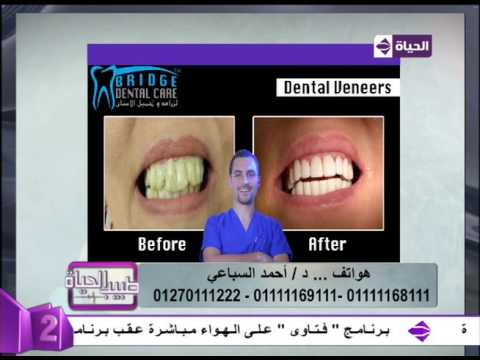 نتائج مُبهرة بعد تجميل الأسنان