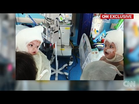 رد فعل والدين لحظة رؤية توأمهما السيامي بعد فصلهما