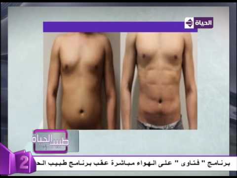 نتائج مبهرة بعد عملية الفيزر