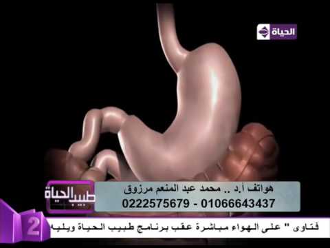 فيديو يوضح كيفية وآلية عمل عملية تكميم المعدة