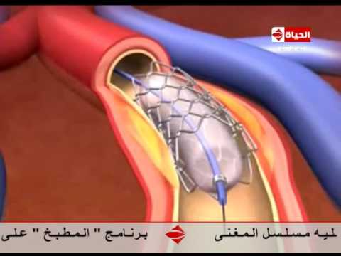 فيديو يوضّح كيفية عمل الدعامة التعويضية في القلب