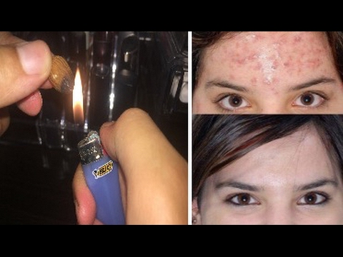 وصفة اللوز المحروق أسرع تقنية لعلاج حبوب الوجه