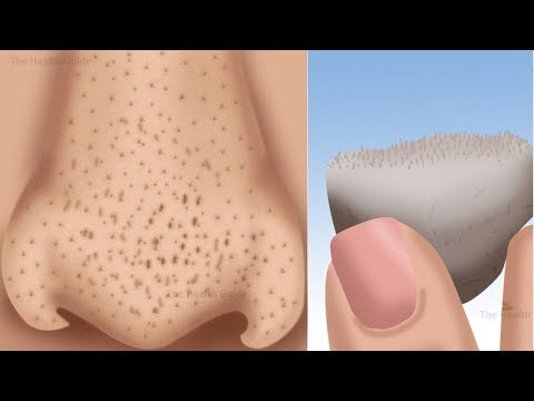 5 طرق لإزالة النقاط السوداء حول أنفك خلال  ثلاث دقائق 