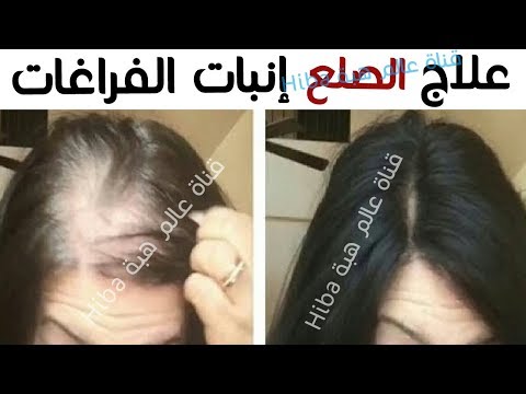 شاهد علاج الصلع وانبات فراغات الراس