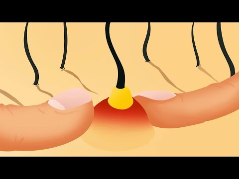 شاهد ماذا يوجد داخل البثور