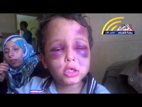 أب يُعذّب ابنه بالضرب على وجهه بـالحديد