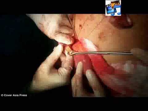 استخراج 12 سبيكة ذهبية من معدة رجل هندي