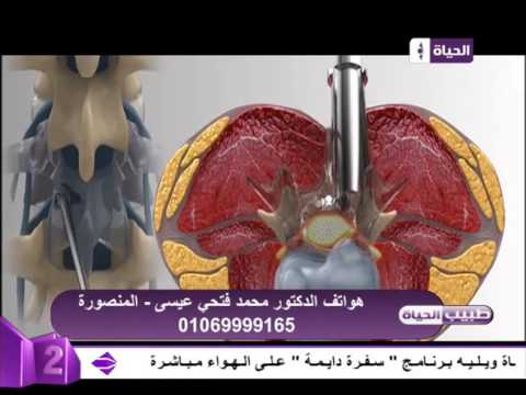 صور توضح إستئصال الغضروف القطني