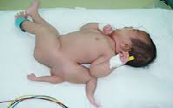 مصر اليوم - سيدة تضع مولودًا بأربعة أرجل في الإسماعيليَّة