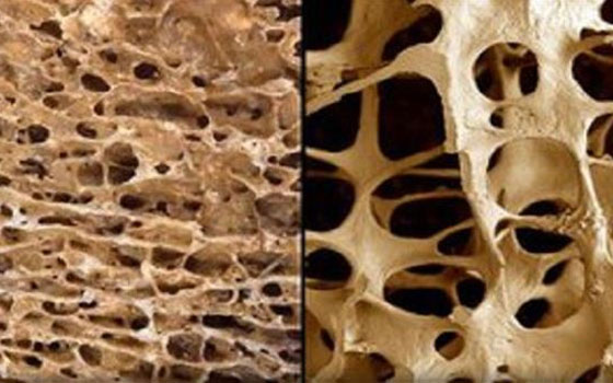   مصر اليوم - باحثون إيرانيون يطورون مواد طبيعية تسرع ترميم العظام