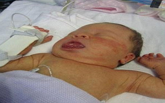   مصر اليوم - طفلة بريطانيا لا يتوقف لسانها عن النمو